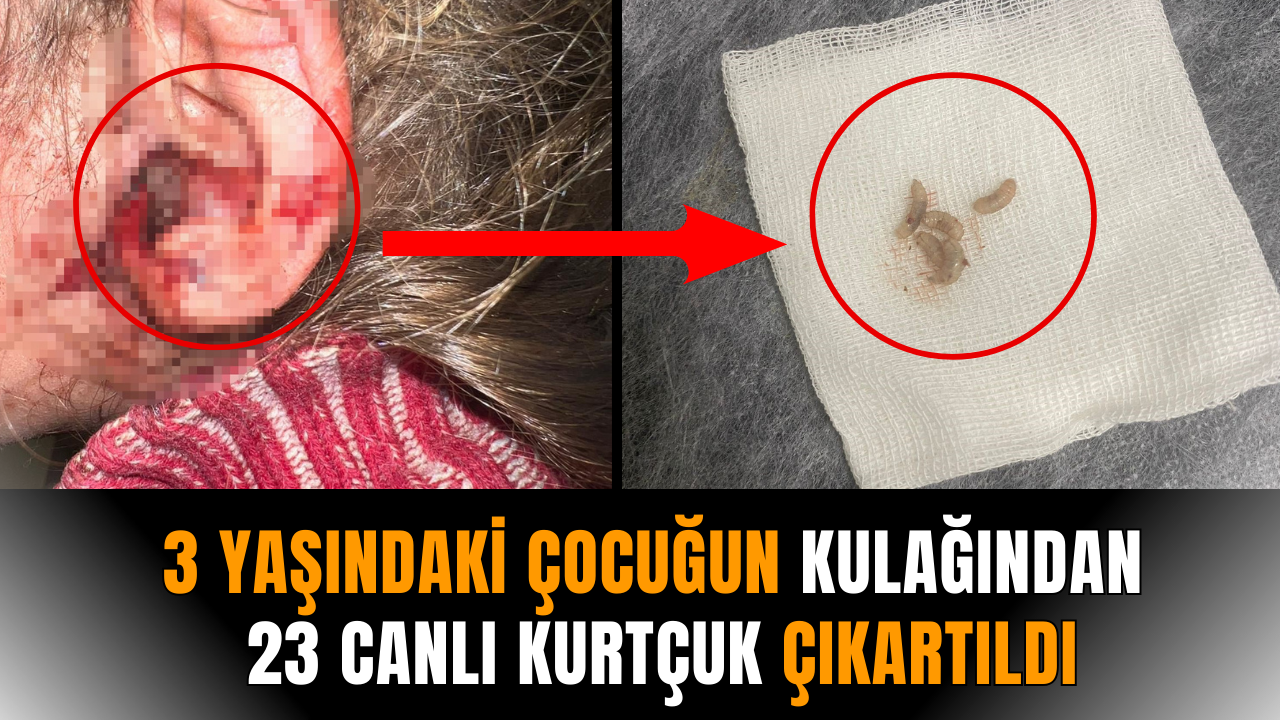 3 yaşındaki çocuğun kulağından 23 canlı kurtçuk çıkartıldı