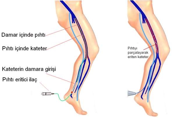 Bacak toplardamarındaki pıhtı ölüme neden olabilir!