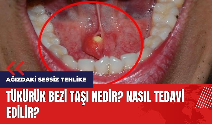 Ağızdaki sessiz tehlike! Tükürük bezi taşı nasıl tedavi edilir?