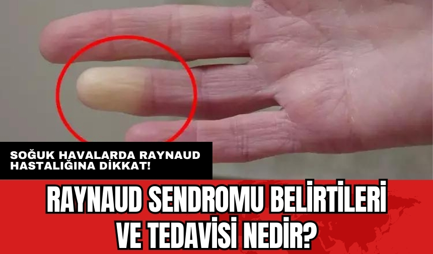 Soğuk havalarda Raynaud hastalığına dikkat! Raynaud sendromu belirtileri ve tedavisi nedir?