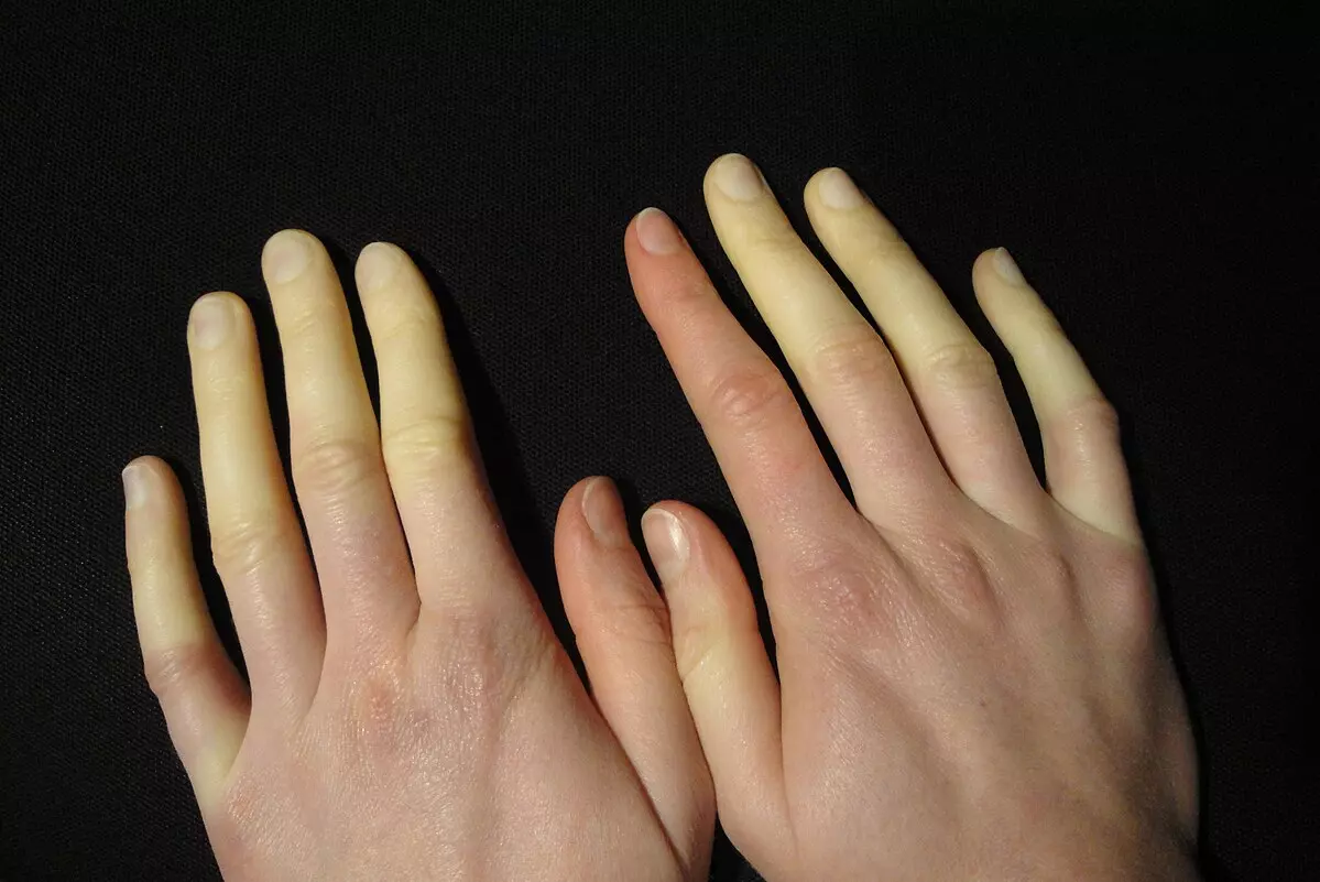 Soğuk Havalarda Raynaud Hastalığına Dikkat!