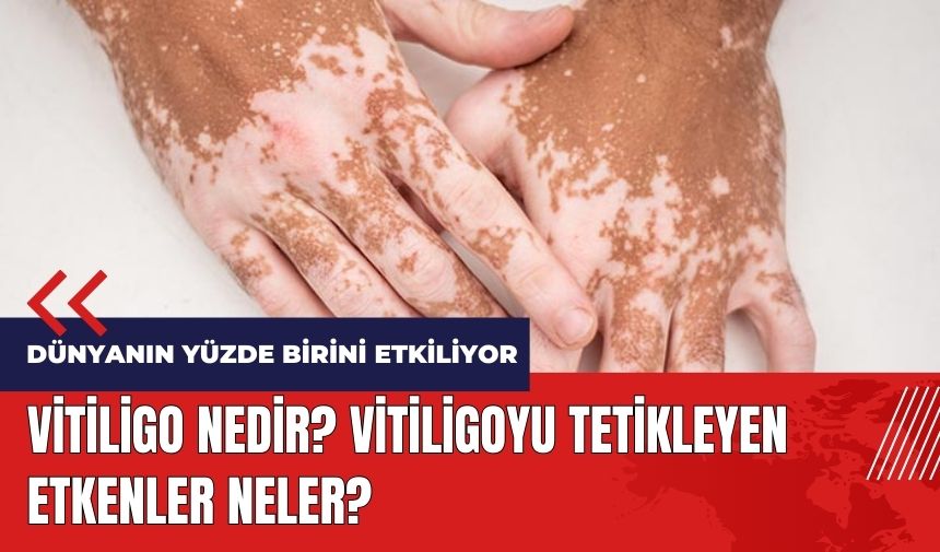 Vitiligo nedir? Vitiligoyu tetikleyen etkenler neler?