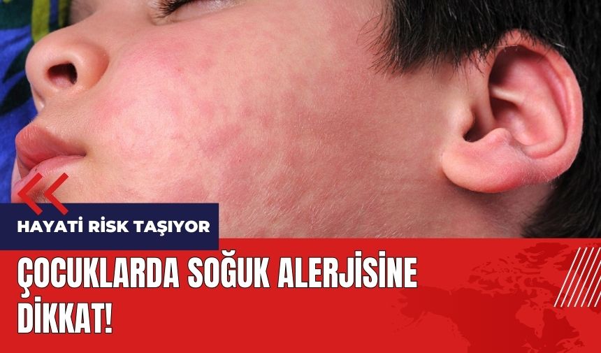 Çocuklarda soğuk alerjisine dikkat! Hayati risk taşıyor