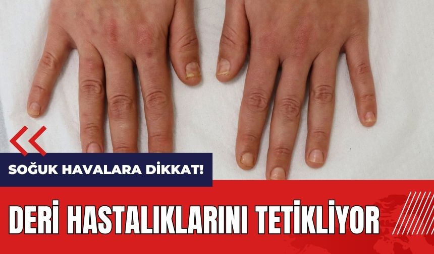 Soğuk havalara dikkat! Deri hastalıklarını tetikliyor