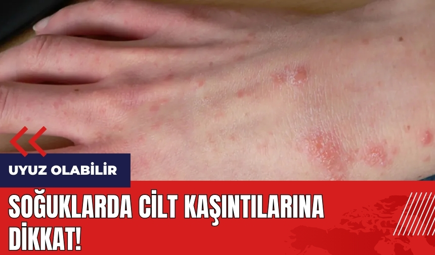 Soğuklarda cilt kaşıntılarına dikkat! Uyuz olabilir