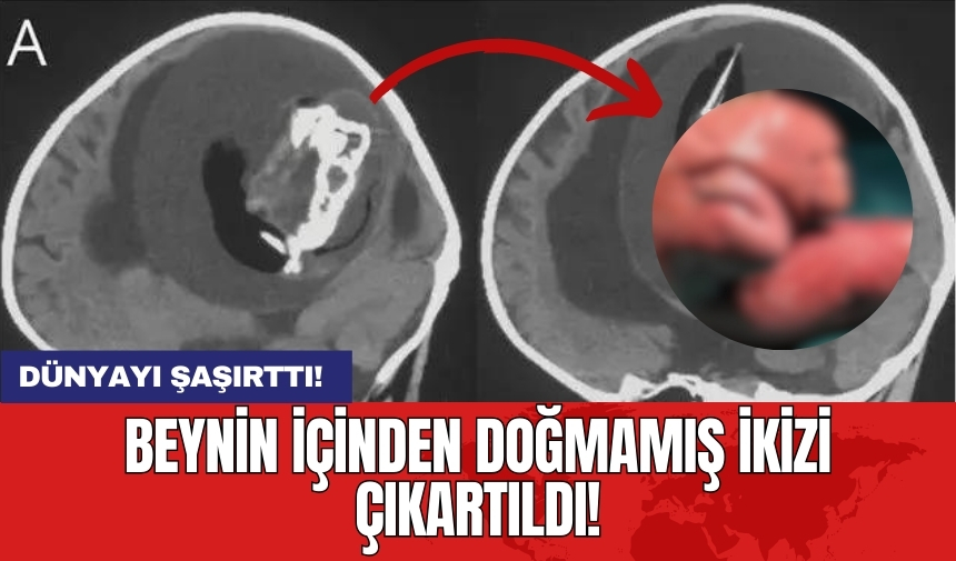 Dünyayı şaşırttı! Beynin içinden doğmamış ikizi çıkartıldı!