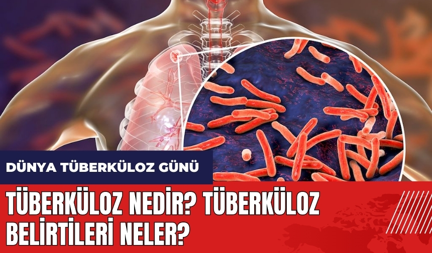 Tüberküloz nedir? Tüberküloz belirtileri neler?