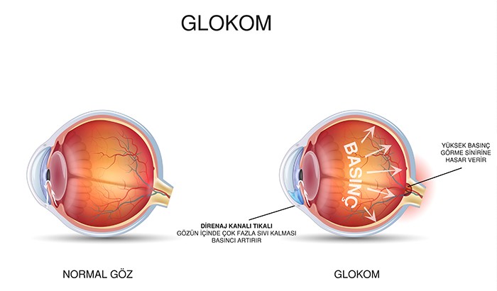 40'Tan Sonra Göz Tansiyonuna Dikkat! Glokom Belirtileri Neler (2)