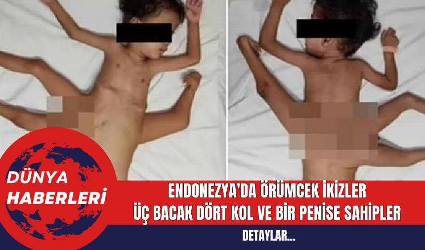 Endonezya'da Örümcek İkizler: Üç Bacak Dört Kol ve Bir Penise Sahipler