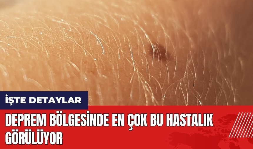 Deprem bölgesinde en çok bu hastalık görülüyor