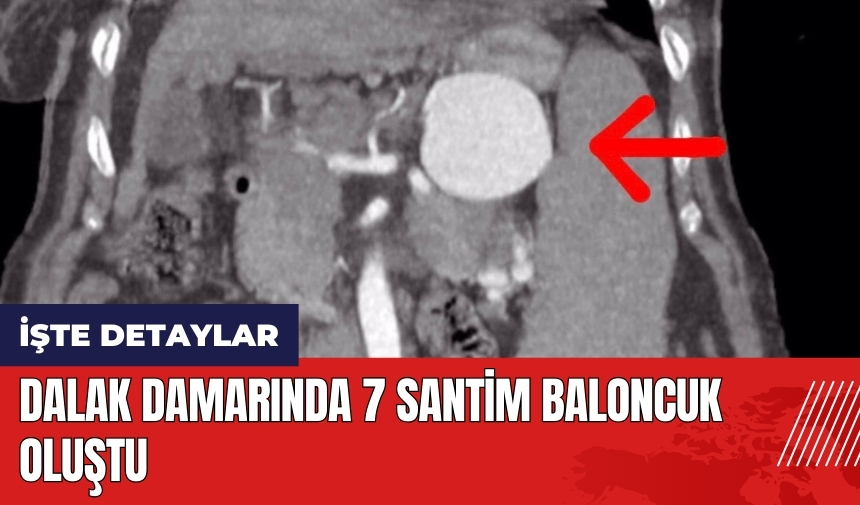 Dalak damarında 7 santim baloncuk oluştu