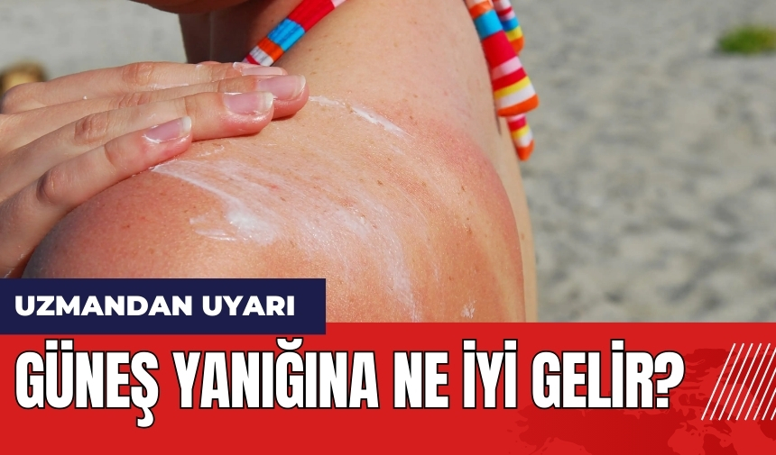 Güneş yanığına ne iyi gelir?