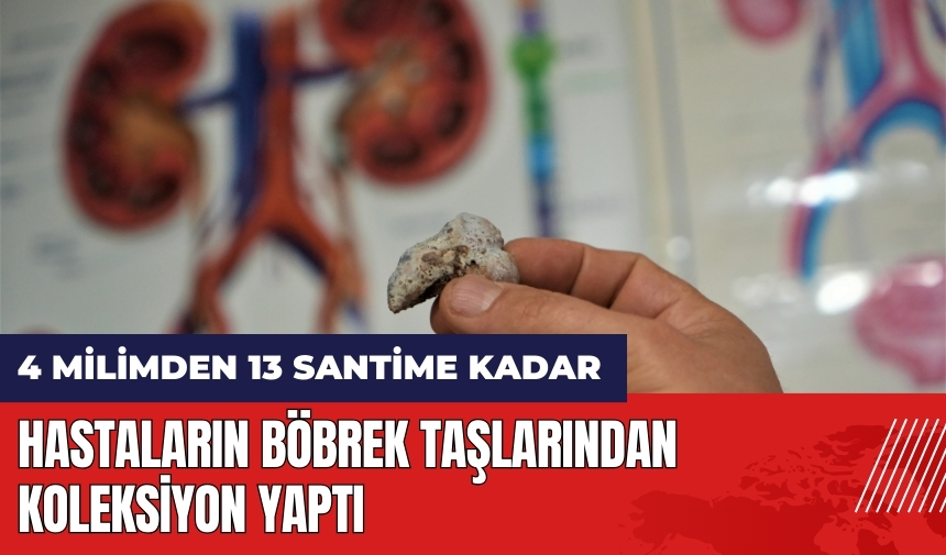 Hastaların böbrek taşlarından koleksiyon yaptı