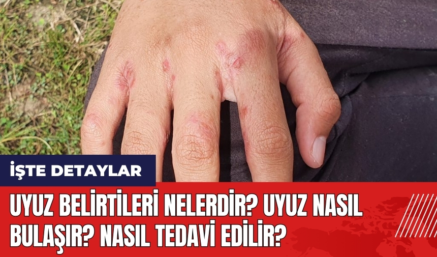 Uyuz belirtileri nelerdir? Uyuz nasıl bulaşır? Nasıl tedavi edilir?