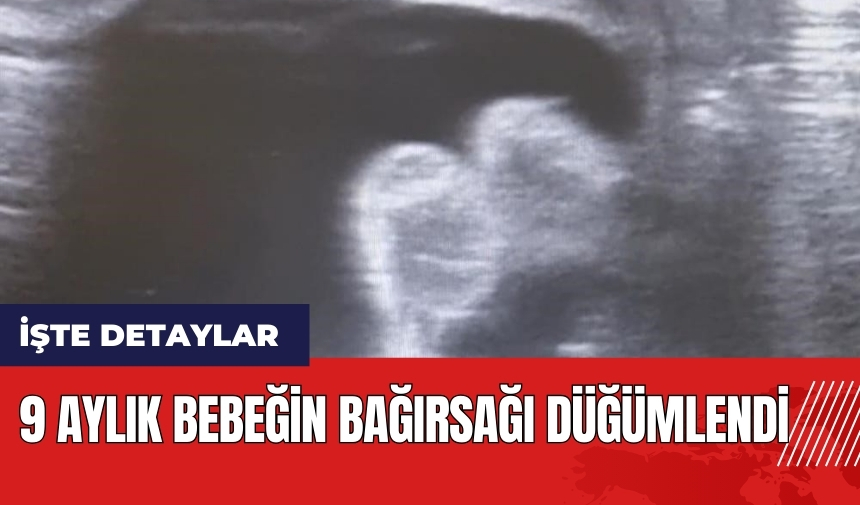 9 aylık bebeğin bağırsağı düğümlendi