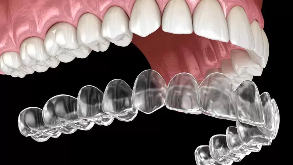 Invisalign Tedavileri 1024X575 1