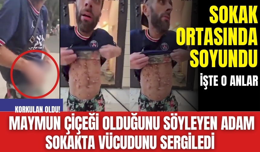 Korkulan oldu! Maymun çiçeği olduğunu söyleyen adam sokakta vücudunu sergiledi