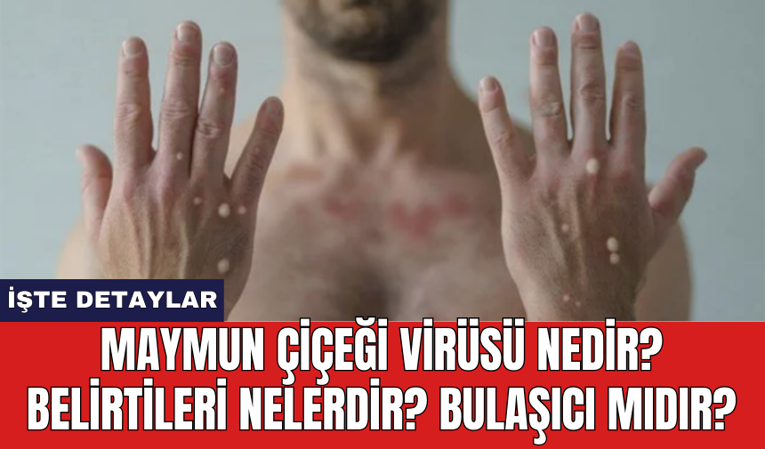 Maymun Çiçeği Virüsü Nedir? Belirtileri Nelerdir? Bulaşıcı Mıdır?