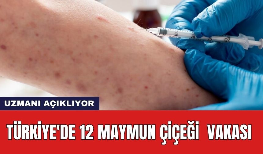 Türkiye'de 12 maymun çiçeği vakası