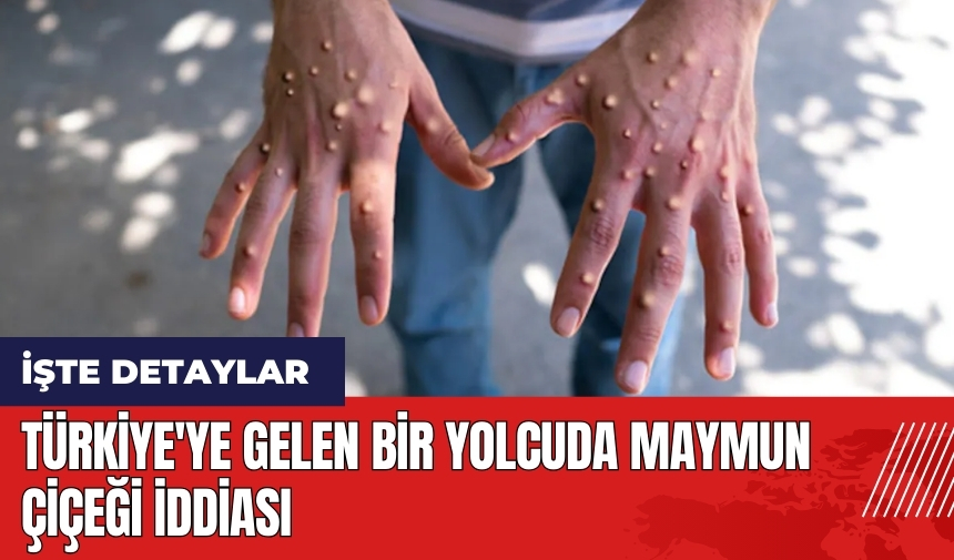 Türkiye'ye gelen bir yolcuda maymun çiçeği iddiası