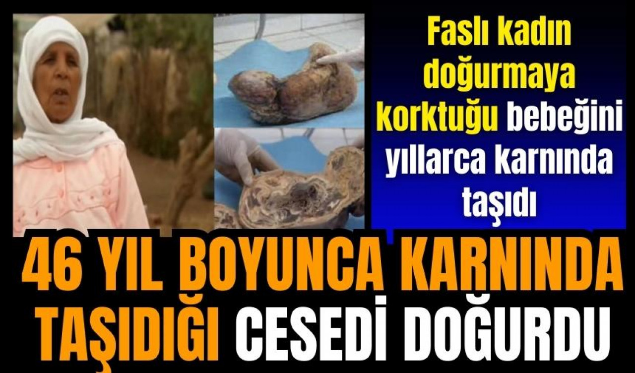 46 yıl boyunca karnında taşıdığı bebeğini doğurdu