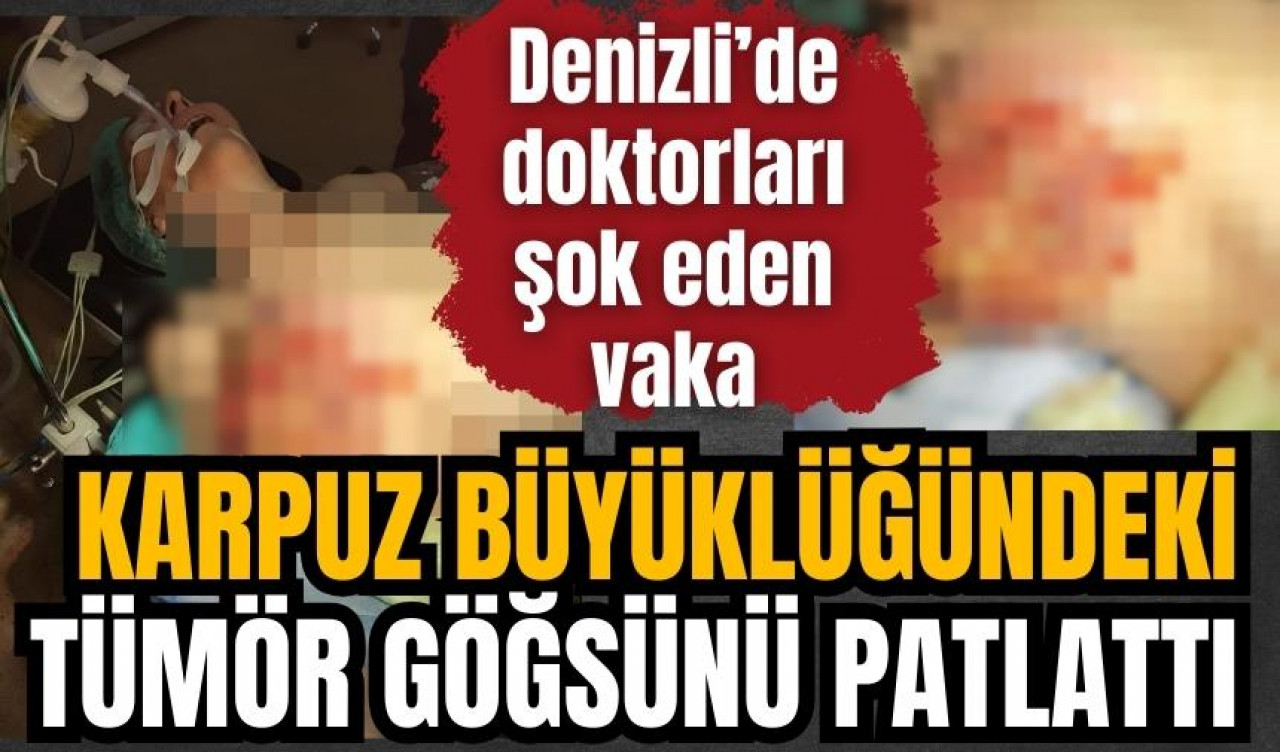 Karpuz büyüklüğündeki tümör göğsünü patlattı