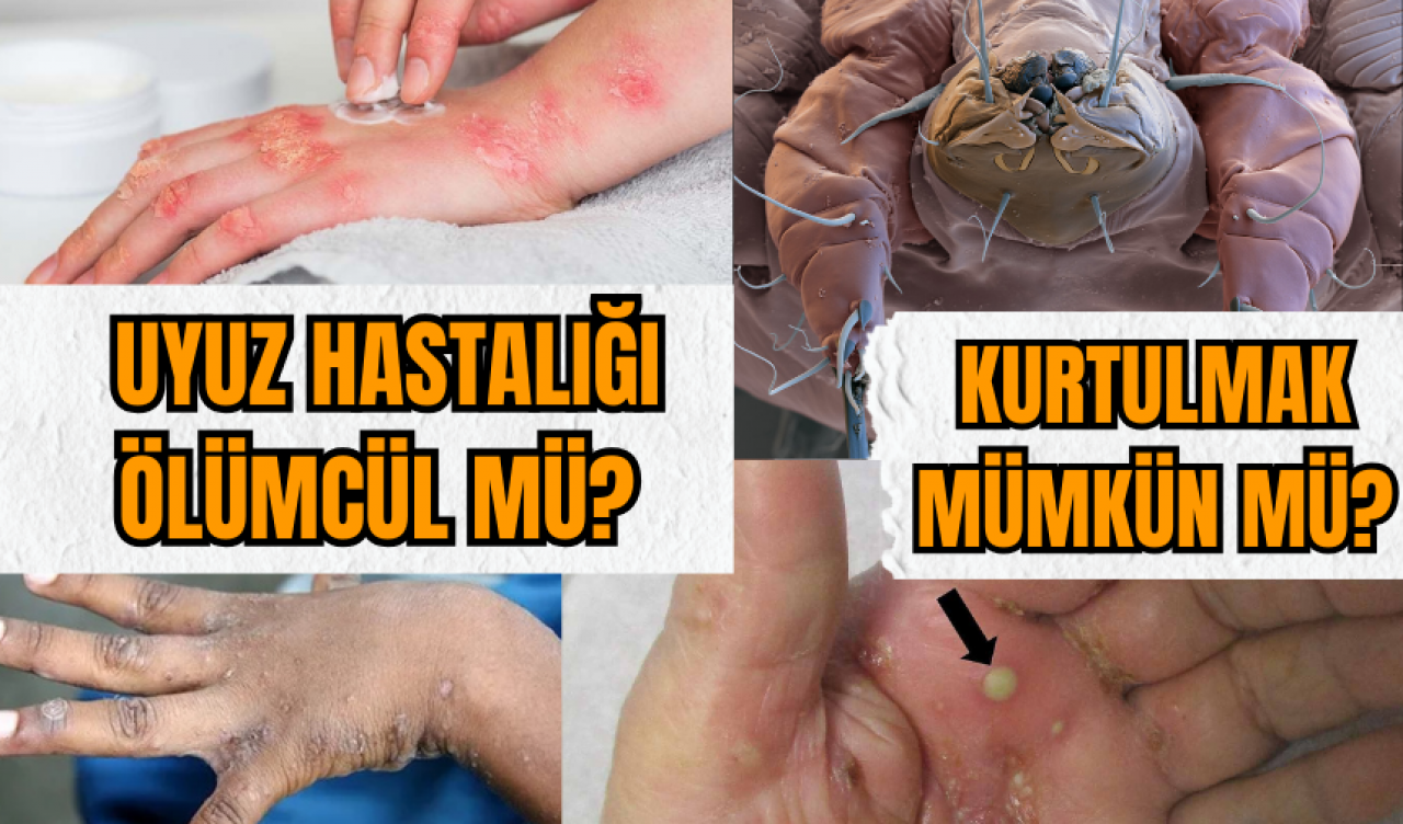 Uyuz hastalığı ölümcül mü? Kurtulmak mümkün mü?