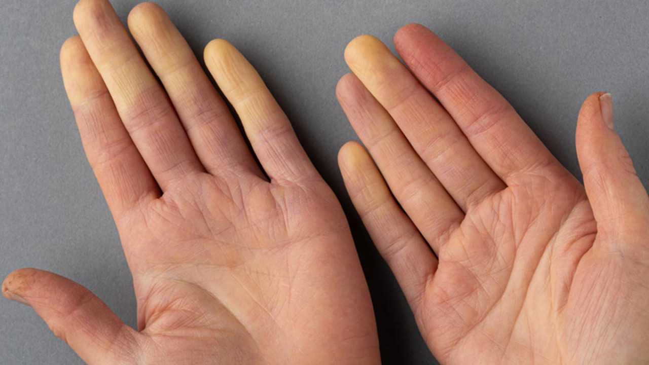 Raynaud hastalığı nedir? Raynaud hastalığına karşı alınan önlemler