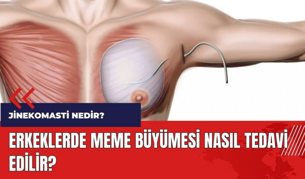 Erkeklerde meme büyümesi nasıl tedavi edilir? Jinekomasti nedir?