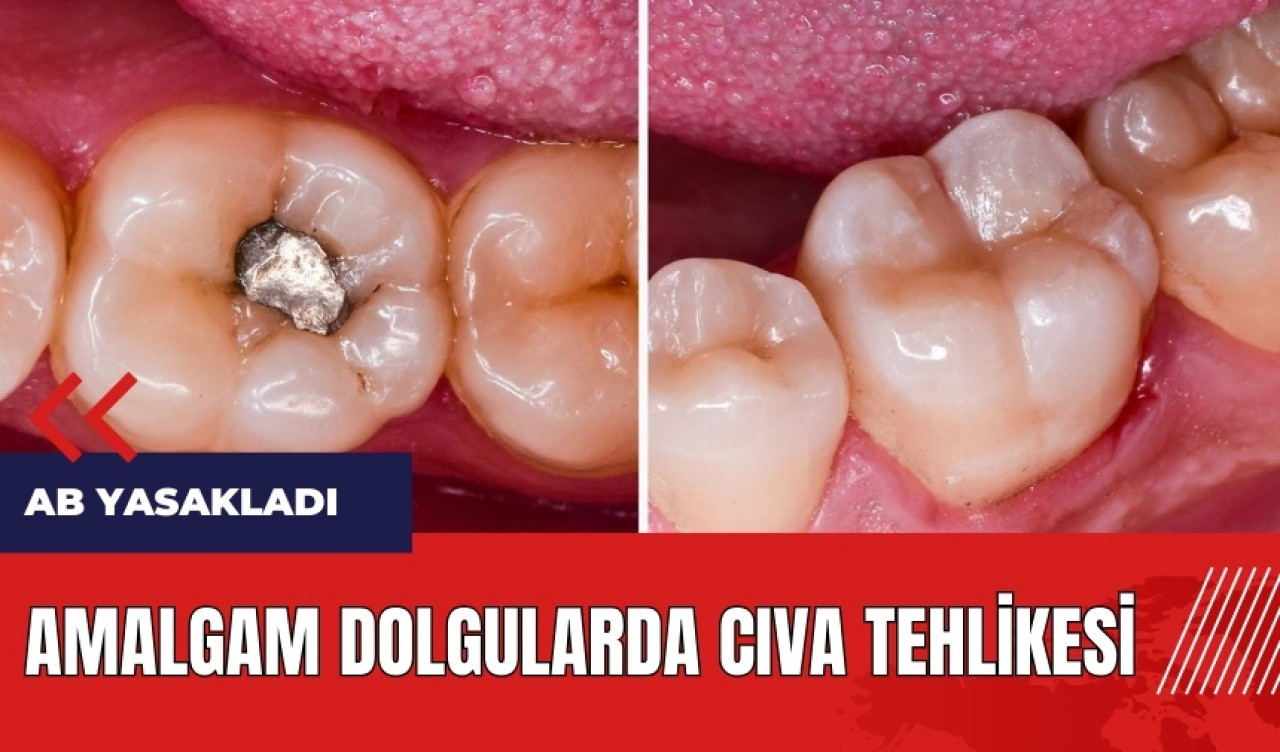 Amalgam dolgularda cıva tehlikesi