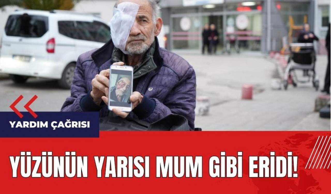 Yüzünün yarısı mum gibi eridi!