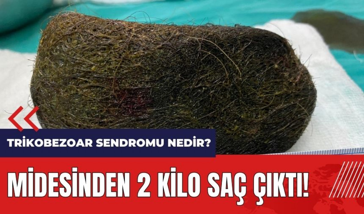 Midesinden 2 kilo saç çıktı! Trikobezoar sendromu nedir?