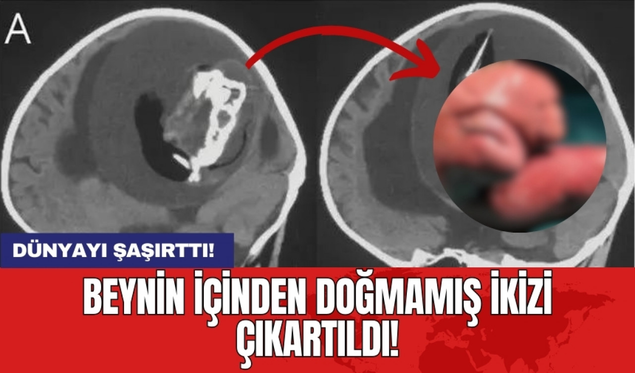 Dünyayı şaşırttı! Beynin içinden doğmamış ikizi çıkartıldı!