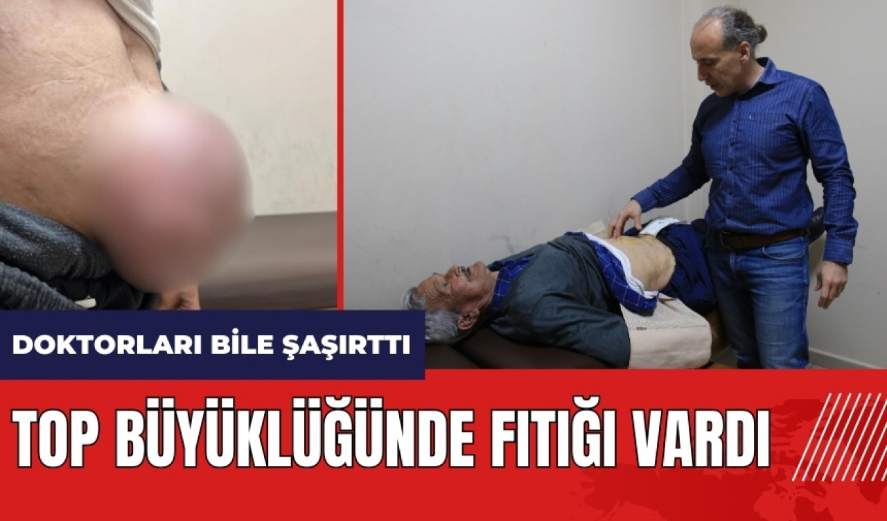 Mersin'de top büyüklüğünde fıtık doktorları bile şaşırttı