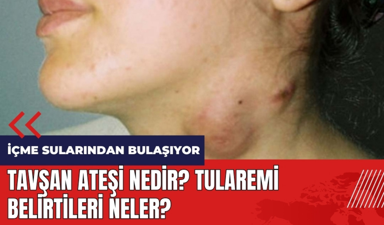 Tavşan ateşi nedir? Tularemi belirtileri neler?