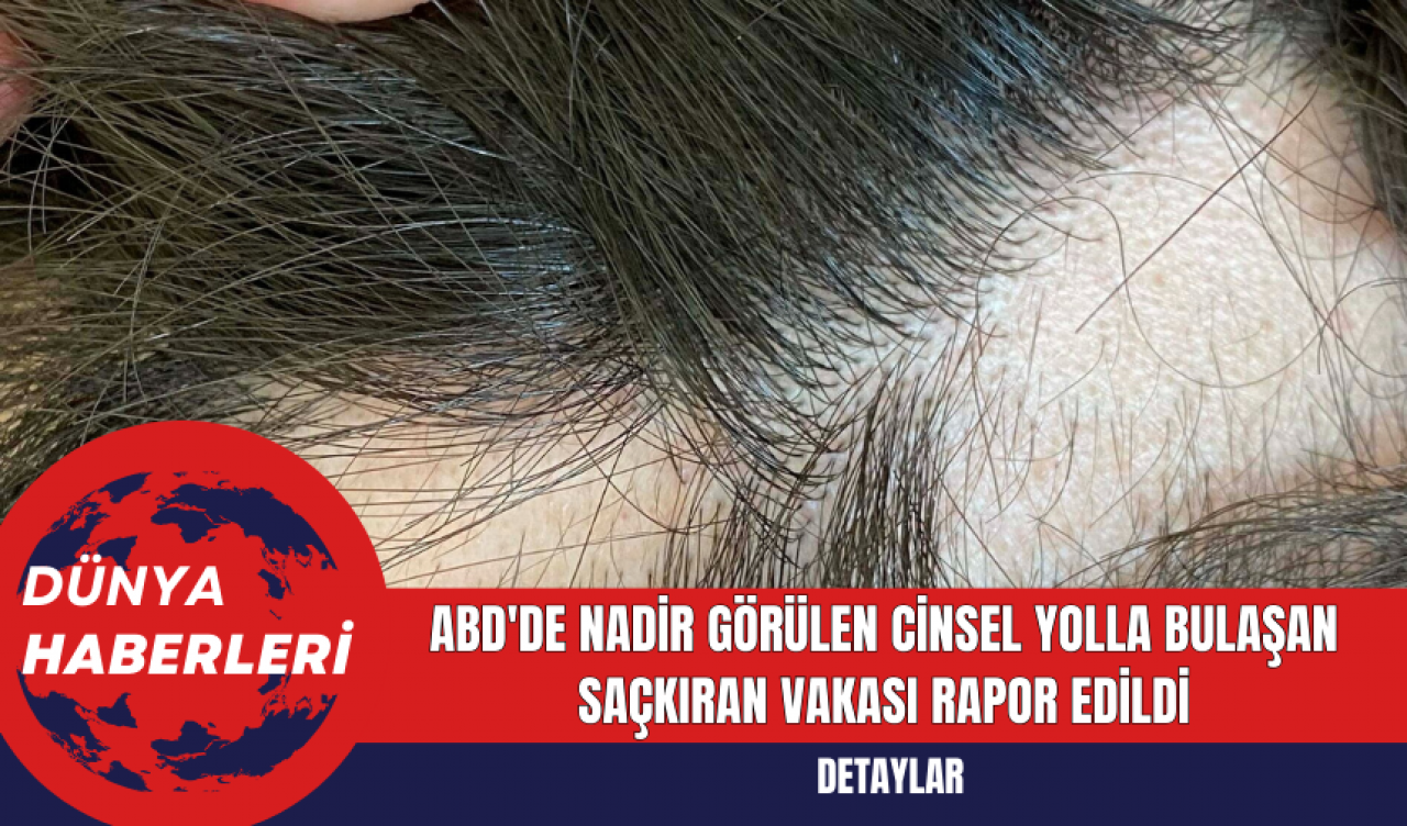 ABD'de Nadir Görülen Cinsel Yolla Bulaşan Saçkıran Vakası Rapor Edildi