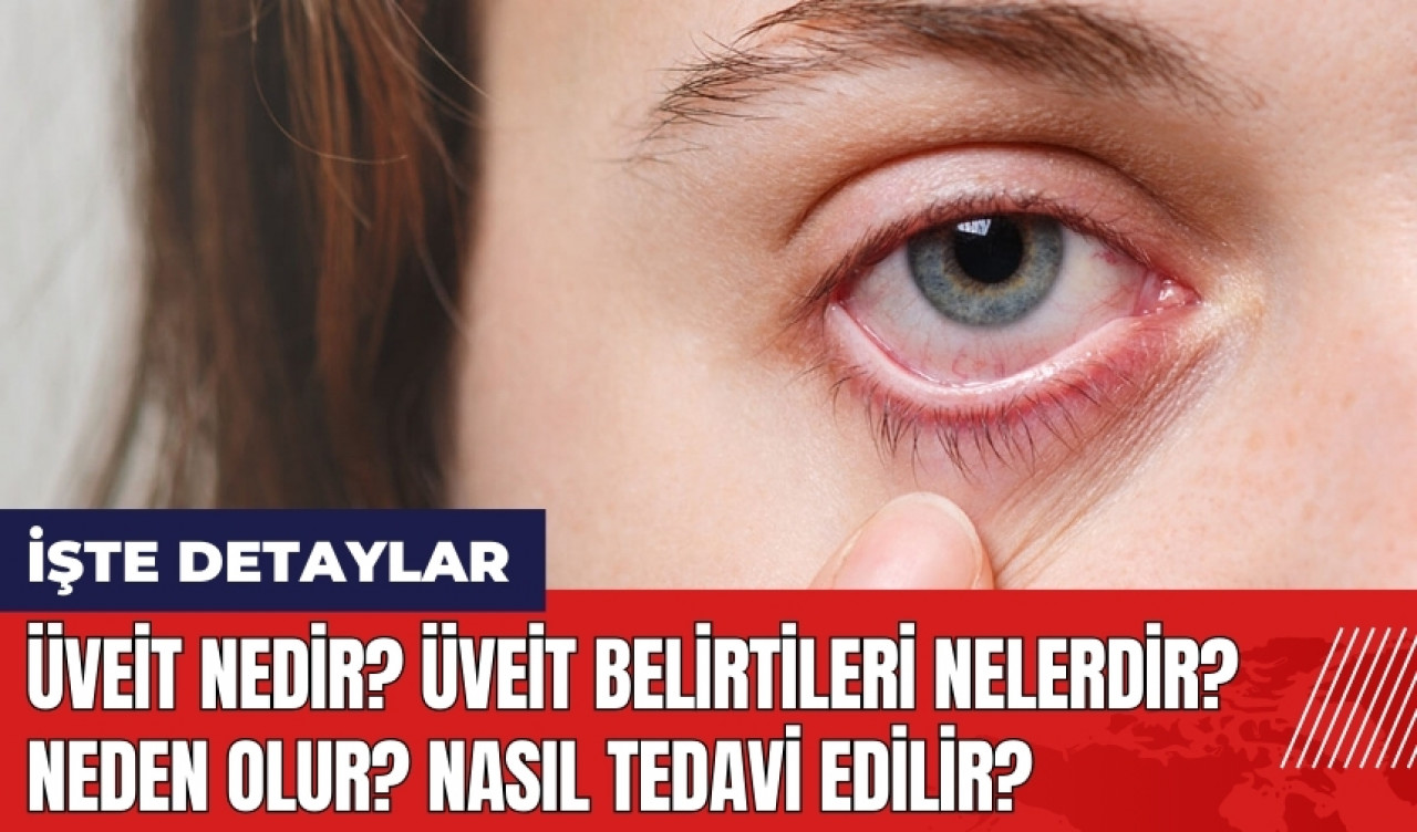 Üveit nedir? Üveit belirtileri nelerdir? Neden olur? Nasıl tedavi edilir?