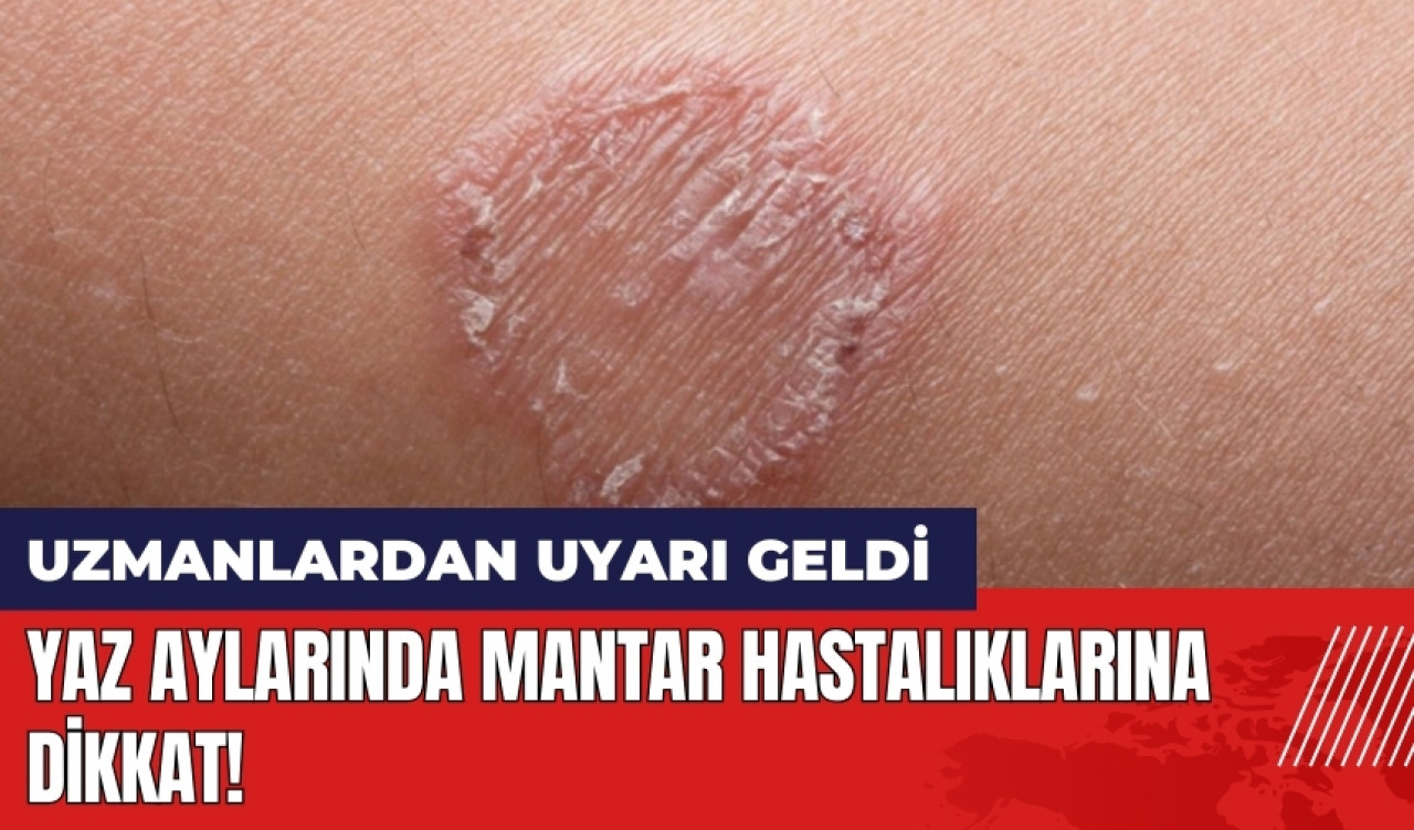 Yaz aylarında mantar hastalıklarına dikkat!