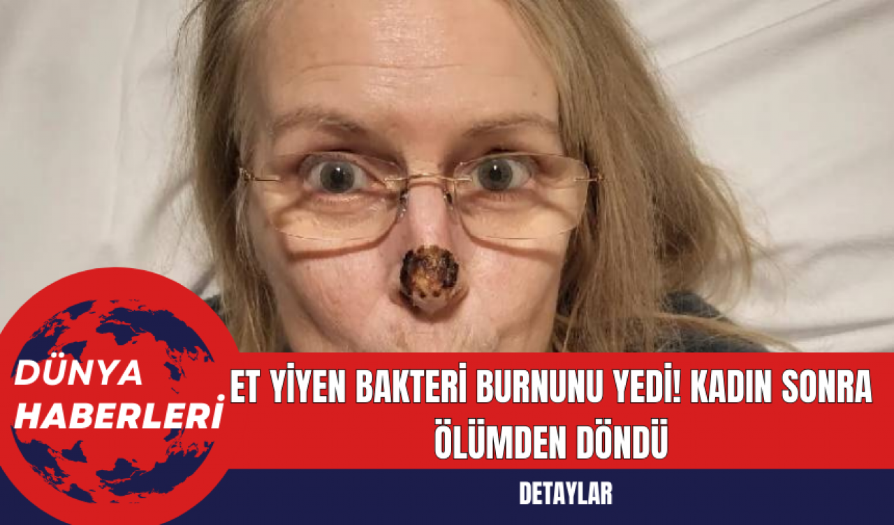 Et Yiyen Bakteri Burnunu Yedi! Kadın Sonra Ölümden Döndü