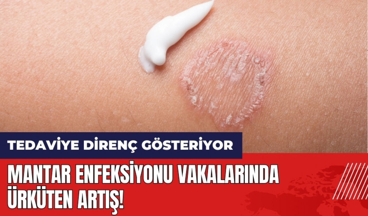 Mantar enfeksiyonu vakalarında ürküten artış! Tedaviye direnç gösteriyor