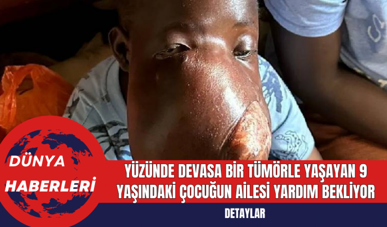 Yüzünde Devasa Bir Tümörle Yaşayan 9 Yaşındaki Çocuğun Ailesi Yardım Bekliyor