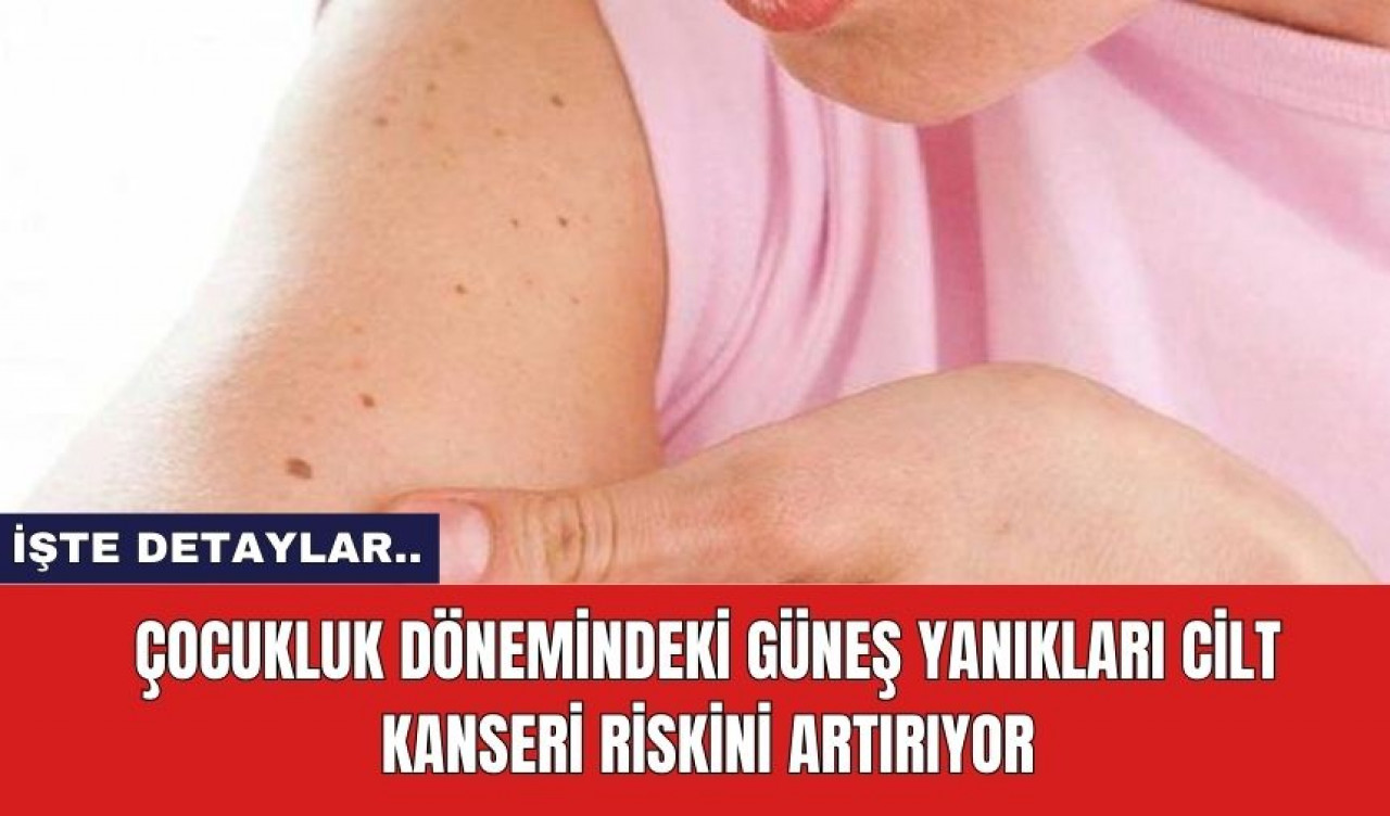 Çocukluk Dönemindeki Güneş Yanıkları Cilt Kanseri Riskini Artırıyor