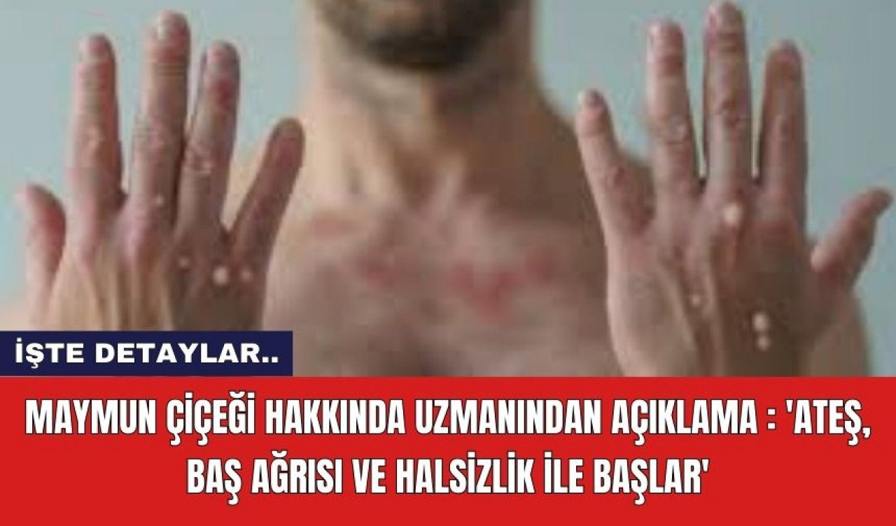 Maymun çiçeği hakkında uzmanından açıklama : 'Ateş, baş ağrısı ve halsizlik ile başlar'