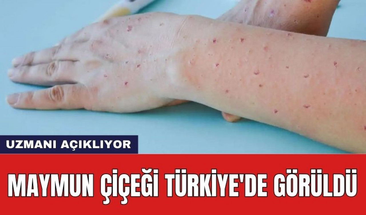 Maymun Çiçeği Türkiye'de Görüldü