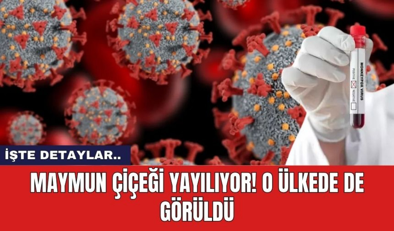 Maymun çiçeği yayılıyor! O Ülkede de görüldü