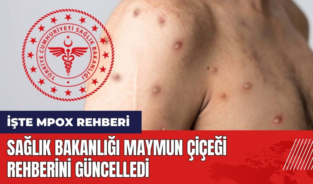 Sağlık Bakanlığı'ndan Maymun Çiçeği rehberi