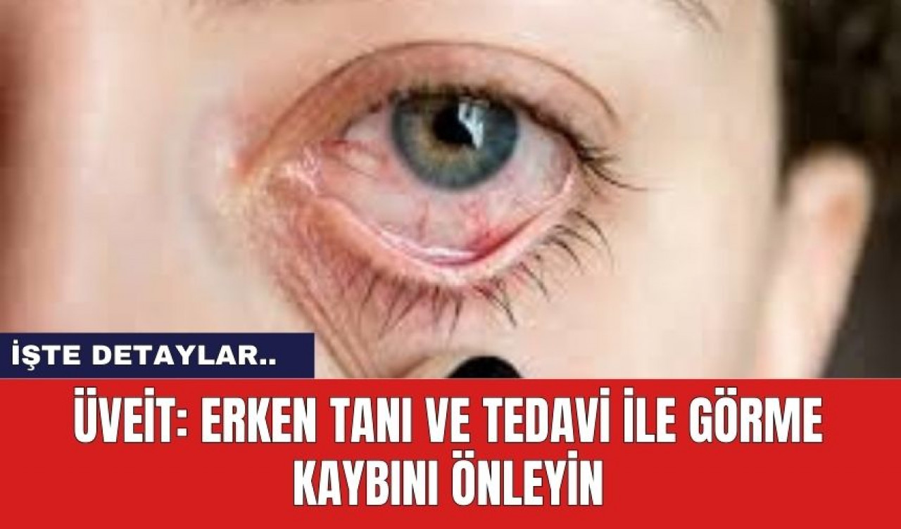 Üveit: Erken Tanı ve Tedavi ile Görme Kaybını Önleyin