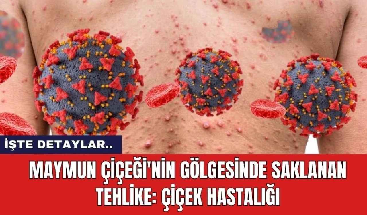 Maymun Çiçeği'nin Gölgesinde Saklanan Tehlike: Çiçek Hastalığı