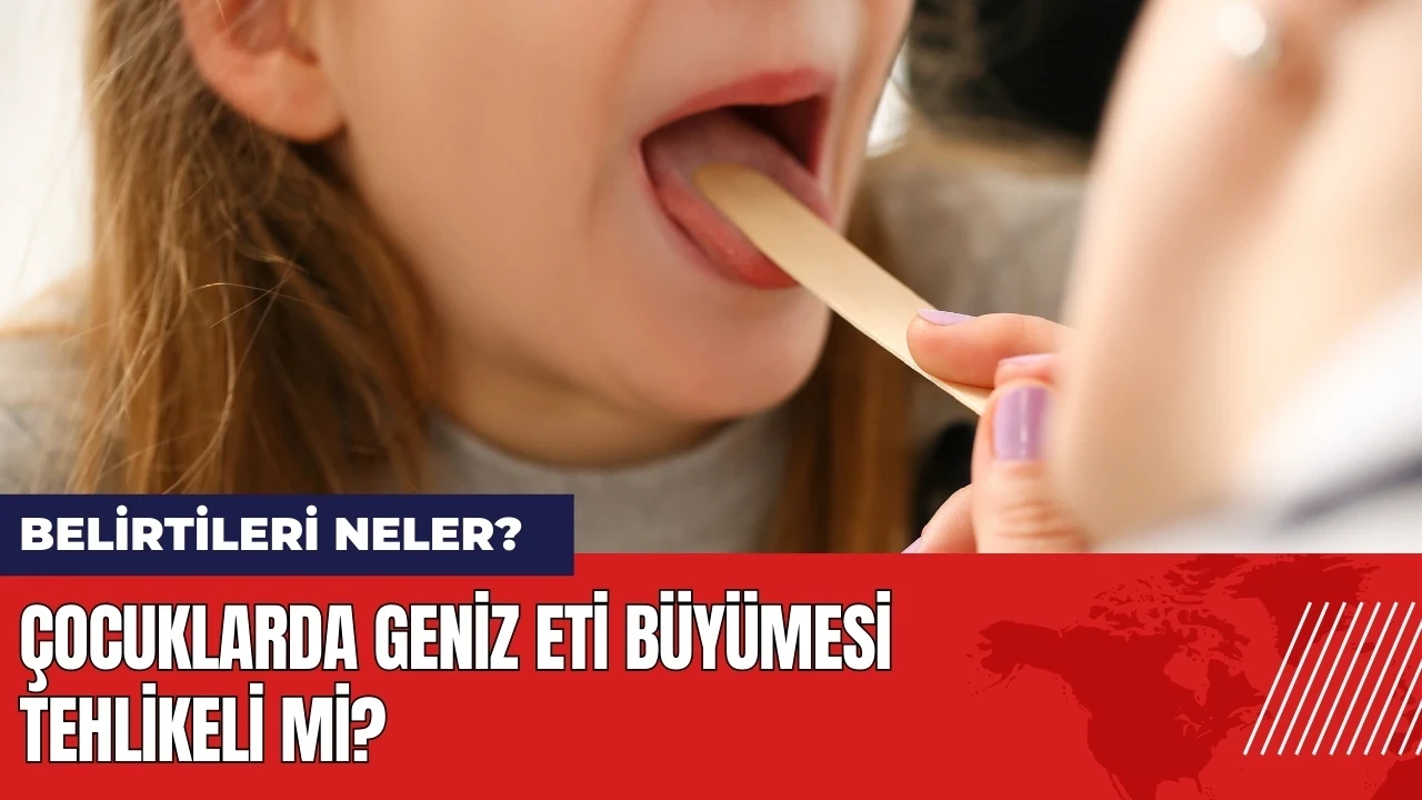 Çocuklarda geniz eti büyümesi tehlikeli mi? Belirtileri neler?