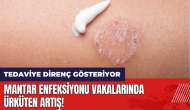 Mantar enfeksiyonu vakalarında ürküten artış! Tedaviye direnç gösteriyor